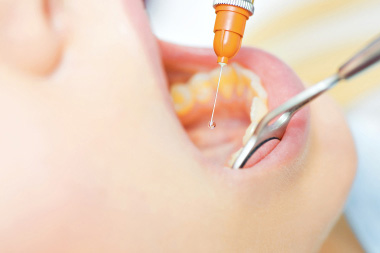 Schmerzfreie Behandlung in der Zahnarztpraxis Wurzen OT Burkartshain